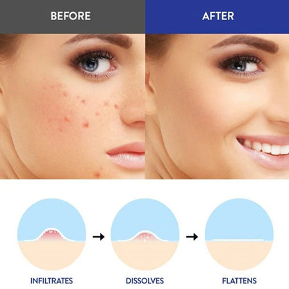 Acne-Zap Microneedle Miracle Patches